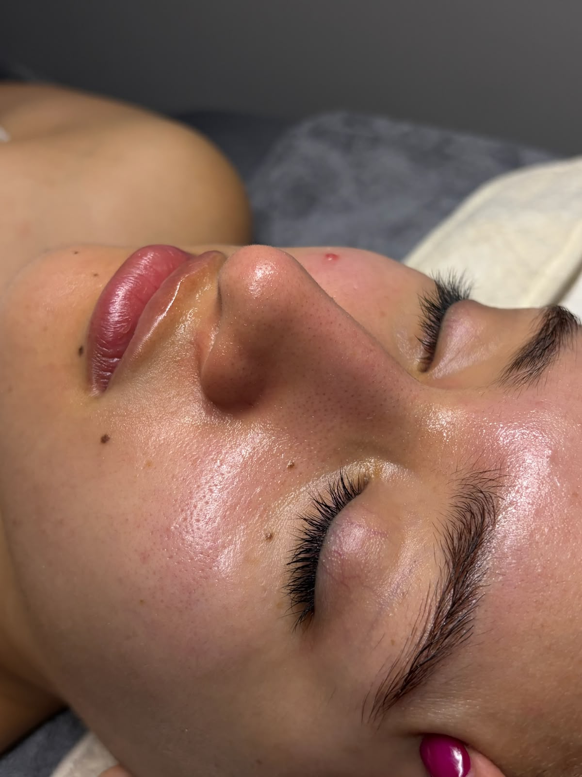 Resultado de tratamiento facial en GlowLab